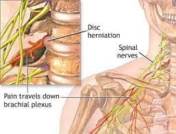 treatment of pinched nerve in the neck
