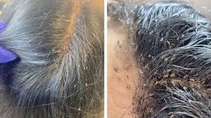 hair clinic remove hundreds of lice