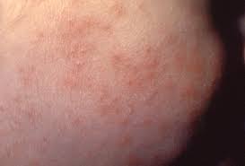 It's more common in meningococcal disease, though, with about 50% of infected people developing petechiae. Meningitis Rash Pictures Symptoms And Similar Rashes