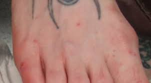My husband tells me off at night for scratching. Derm Dx An Itchy Rash On The Feet And Hands Clinical Advisor