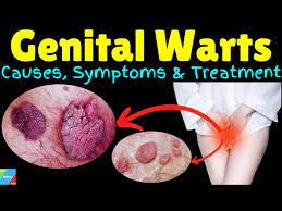 warts symptoms causes