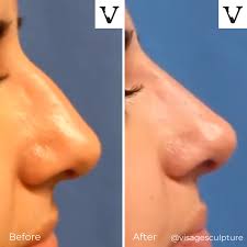 crooked nose straighter visage sculpture