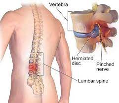 Jika anda khawatir bahwa sakit punggung bagian bawah bisa jadi adalah kanker, segera konsultasikan dengan dokter. Tulang Petua Hilangkan Sakit Pinggang Cara Kampung Facebook
