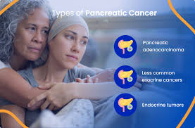 pancreatic cancer everything you need