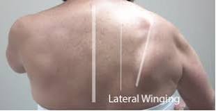 Image result for icd 10 code for winged scapula