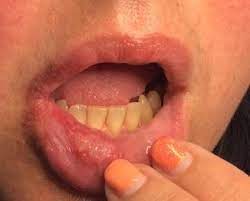 recur blisters on the lip the bmj