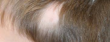 alopecia arata zin