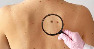 melanoma may help detect skin cancer early