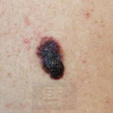 Skin cancer is by far the most common type of cancer. Skin Cancer And Precancerous Skin Lesions What You Need To Know Skin Enhance And Wellness