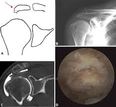 These pictures of this page are about:acromion types mri Classification And Clinical Significance Of Acromial Spur In Rotator Cuff Tear Heel Type Spur And Rotator Cuff Tear Abstract Europe Pmc