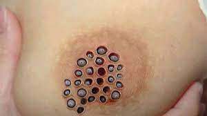 Is This a Breast Rash Caused by South American Larvae? | Snopes.com