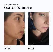 acne scar healing cream vitamin e