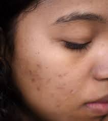 how to remove acne scars naturally be