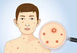 Did You Know About These Causes And Symptoms Of Chickenpox