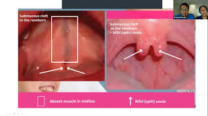 isolated cleft palates