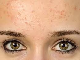 acne face map causes of breakouts