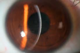 There are three major categories (some doctors use four). Epithelial Basement Membrane Dystrophy After Femtosecond Laser Assisted Laser In Situ Keratomileusis Canadian Journal Of Ophthalmology