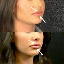 1 syringe of juvederm xc for lips