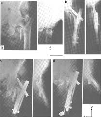 gamma nail in the treatment of closed