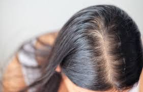 pcos hair loss symptoms causes and