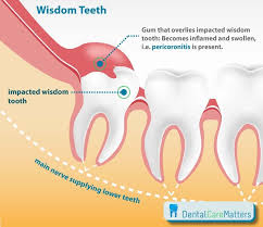 pericoronitis laser treatment in london