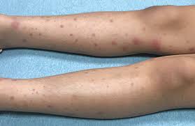 History and examination are adequate to make a diagnosis in children > 36 months who are otherwise well and. Rash Triggers Joint Pain In An 8 Year Old Girl Contemporary Pediatrics