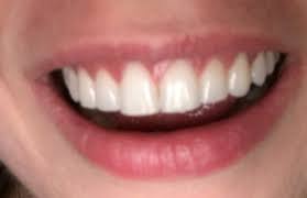 Your teeth look crowded or crooked. Your Opinion On My Teeth After Braces Is There Anything I Can Do I Think That My Front Teeth Stick Out After Braces Photo