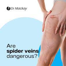 are spider veins dangerous dr