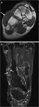 Subscribe to foot & ankle problems. Mri Imaging Of Soft Tissue Tumours Of The Foot And Ankle Insights Into Imaging Full Text