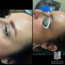 removing eyebrow microblading with