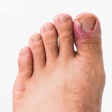 ingrown toenails sunnyside foot and