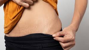 what are stretch marks and can you get