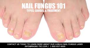 nail fungus 101 types causes