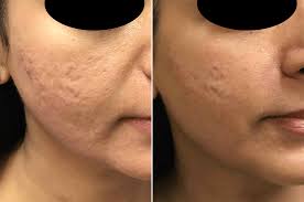 rf microneedling for acne scars on