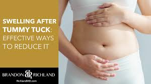 swelling after tummy tuck effective