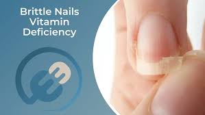 brittle nails vitamin deficiency