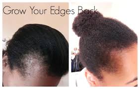 Inventive ways to cover bald spots abound; Get Those Edges Back How To Grow Edges And Bald Spots Natural Hair Styles Edges Hair Bald Hair