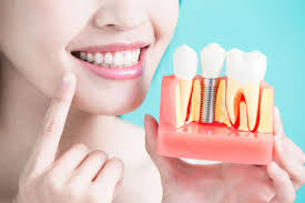 advanes of dental implants