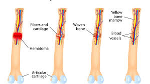 what is the bone healing process dr