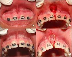 l frenectomy with nd yag laser and