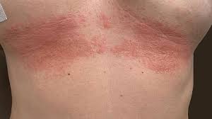 Intertrigo frequently is worsened or colonized by infection, which most commonly is candidal but also may be bacterial or viral or due to other fungal infection. Intertrigo Hautwolf Ursachen Und Behandlung Zava Dred