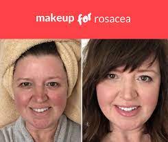how i cover rosacea without looking