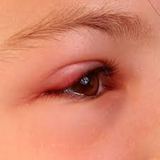 swollen eyelid symptoms treatment