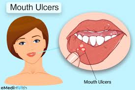 mouth ulcers types symptoms and