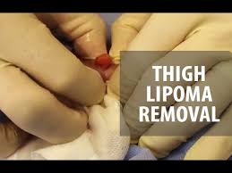 2 thigh lipomas dr derm you