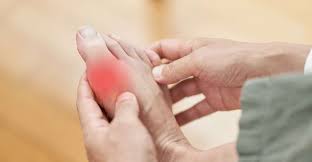 gota o artritis gotosa y la inflamación