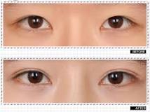 is-double-eyelid-glue-or-tape-better