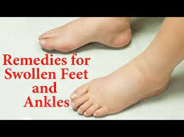10 natural remes for swollen feet