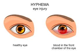 understanding hyphema symptoms