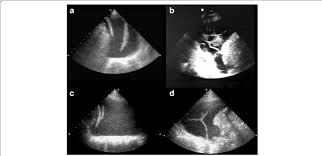 pleural effusion on ultrasound scan